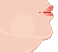 Lipoaspiration-intervention