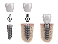 Implants-dentaires-intervention